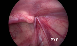 疝气手术视频,从术前准备到术后恢复